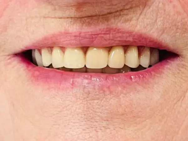 Después del implante dental