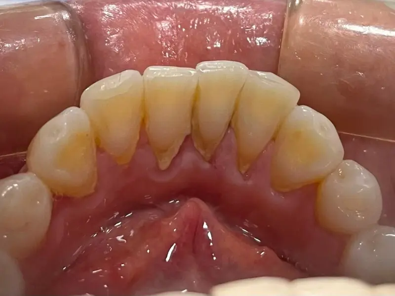 Antes: rehabilitación oral completa