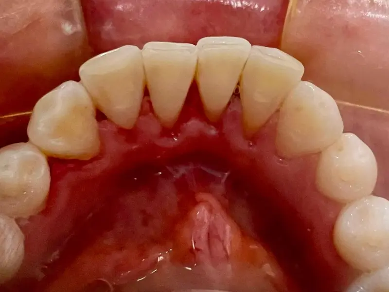 Después: rehabilitación oral completa