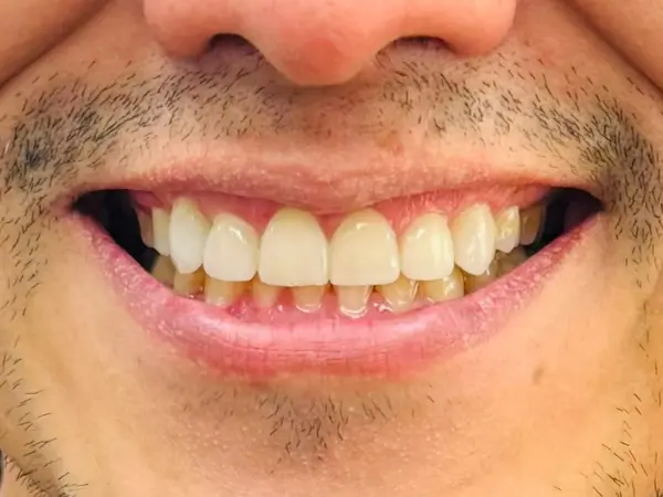 Después del diseño de sonrisa